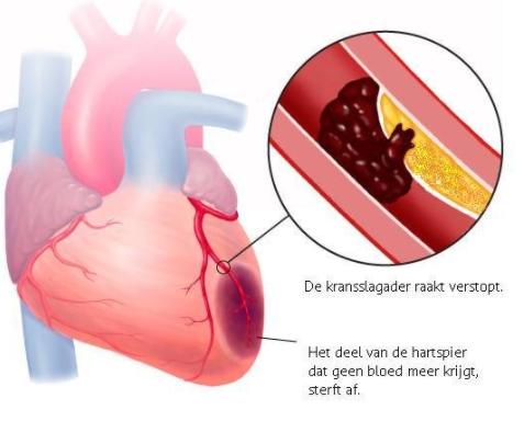 Wat is het verschil tussen een hartinfarct en een hartaanval ?