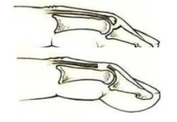 malletvinger of hamervinger